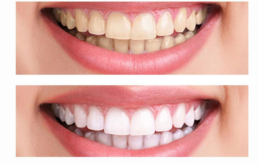 Teeth-Whitening-gel