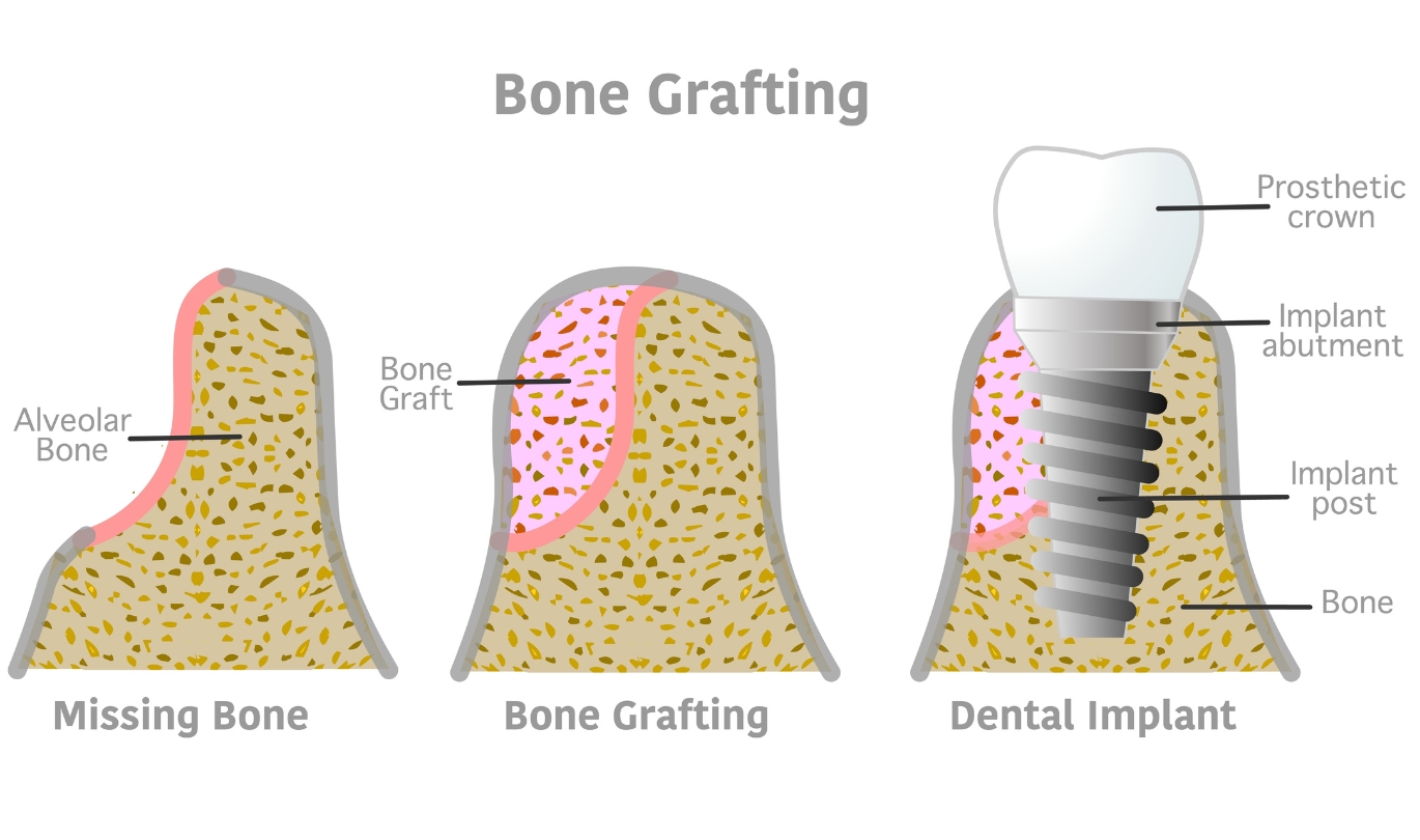 Bone Grafting