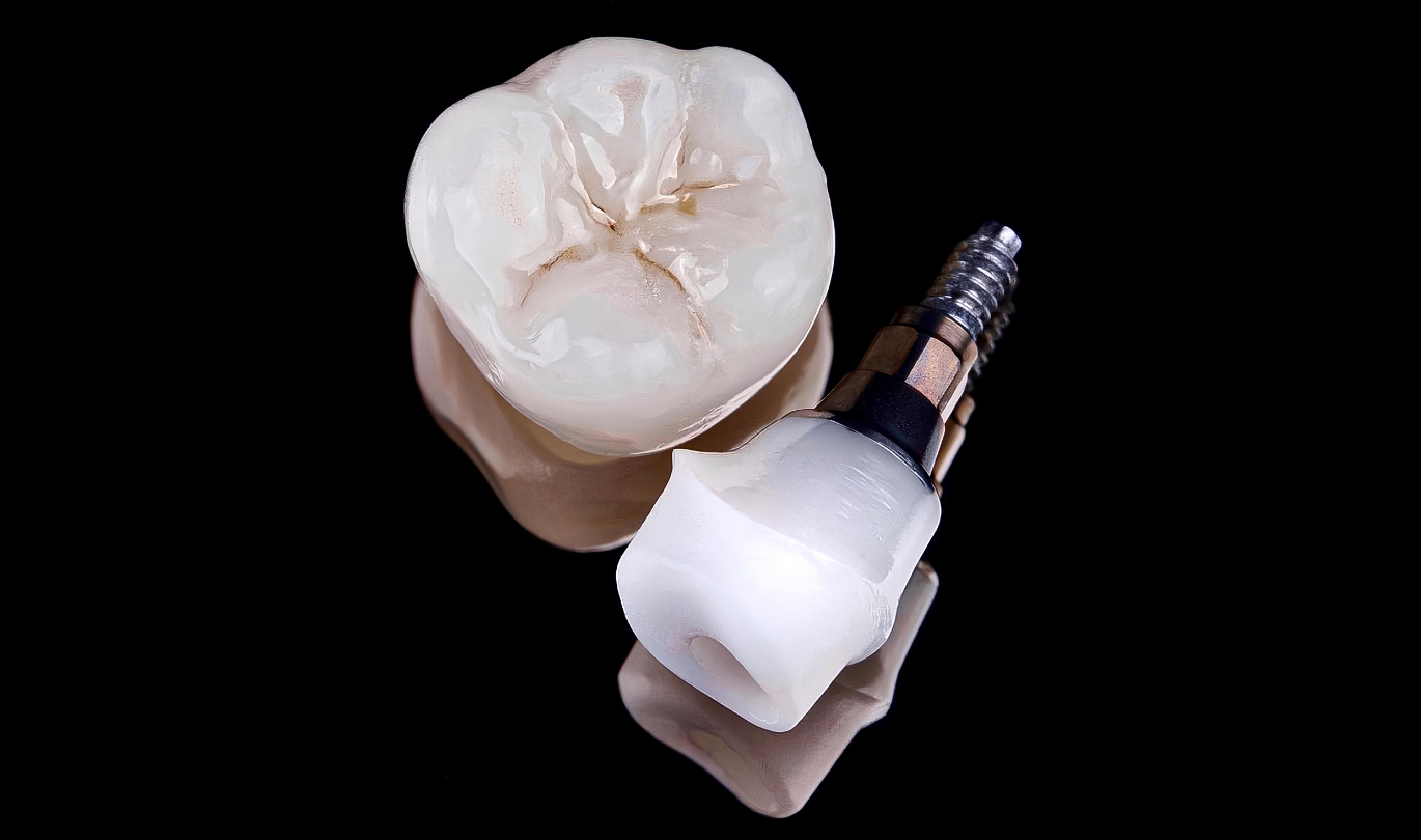 Implant-Retained Crowns and Bridges