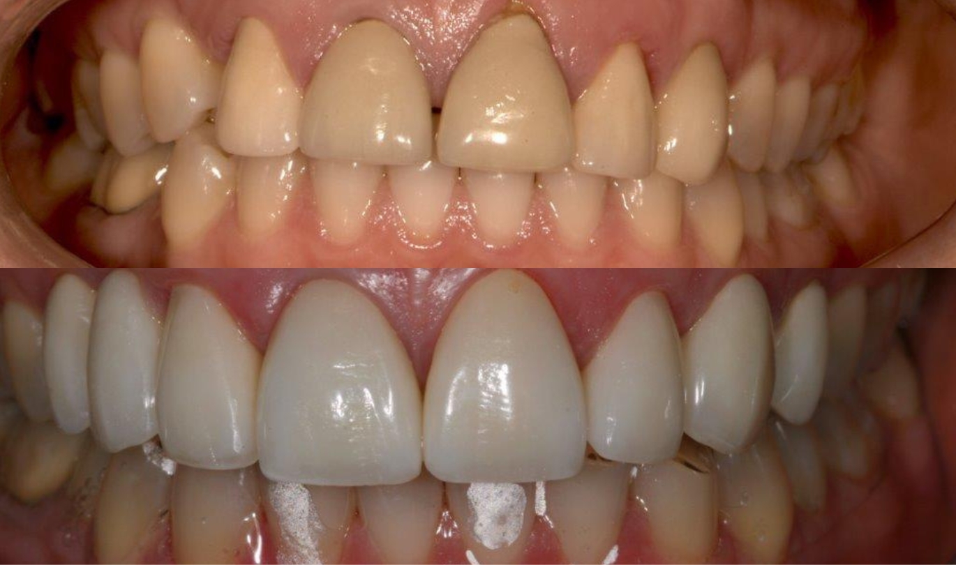 Porcelain Veneers before and after