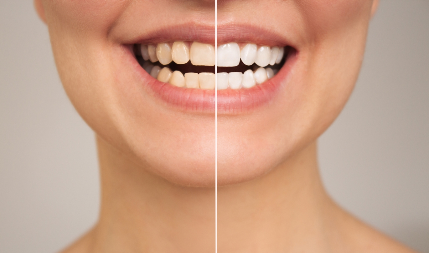 Tooth Whitening