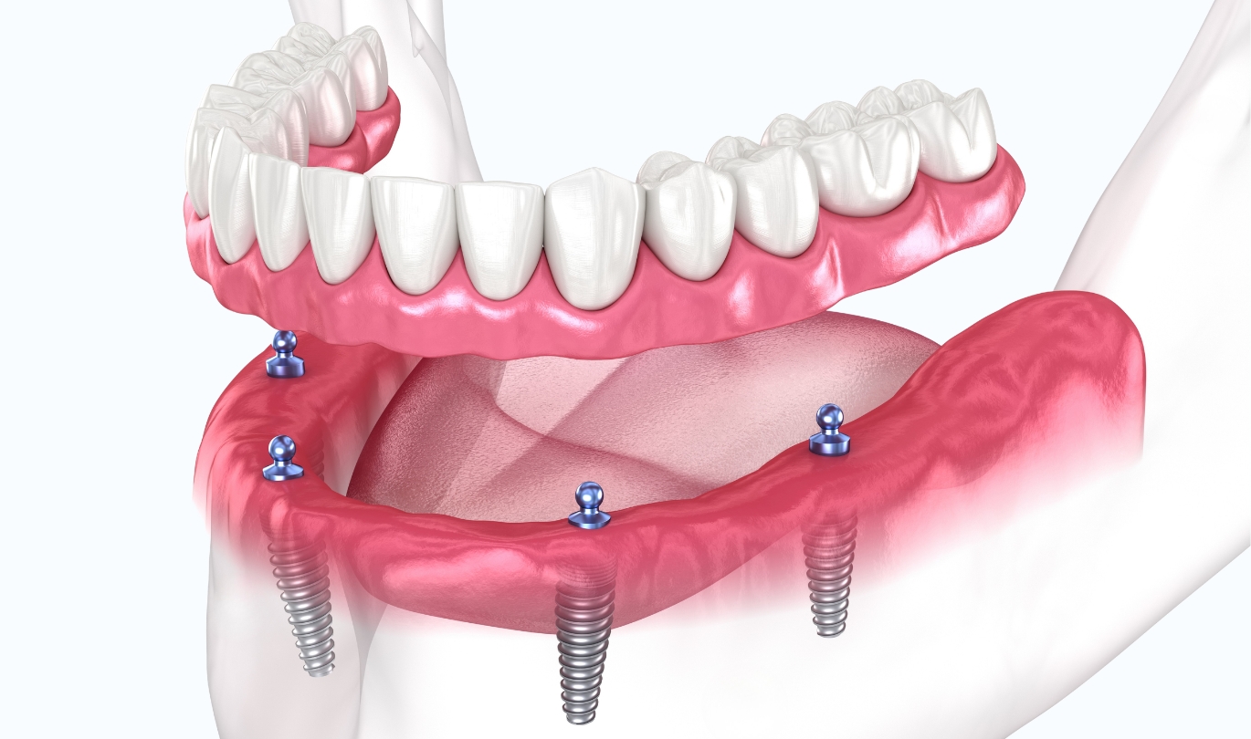 Implant retained dentures
