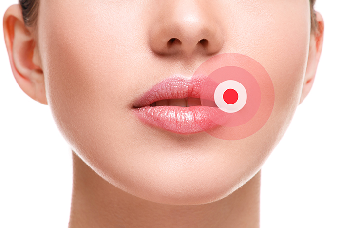 Female lips affected by herpes virus