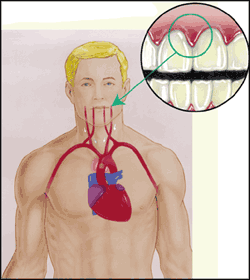 gum-disease-heart-disease