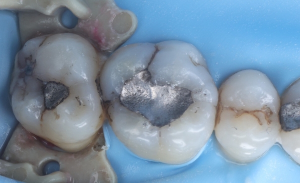 Safe amalgam removal before