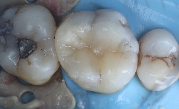 Safe amalgam removal after