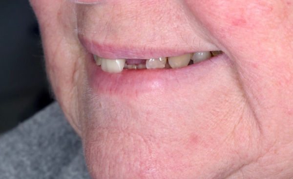 Full Mouth Rehab before