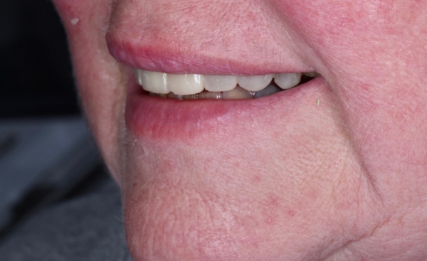 Full Mouth Rehab after