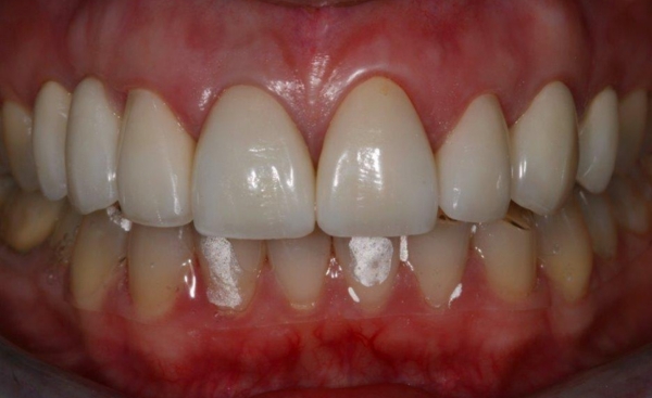 Porcelain Veneers after
