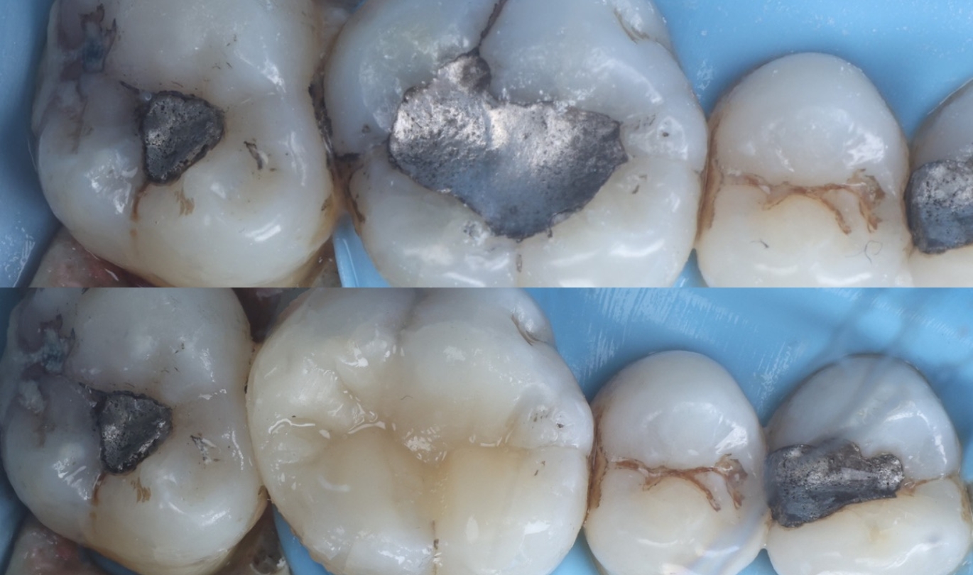Safe Amalgam Removal