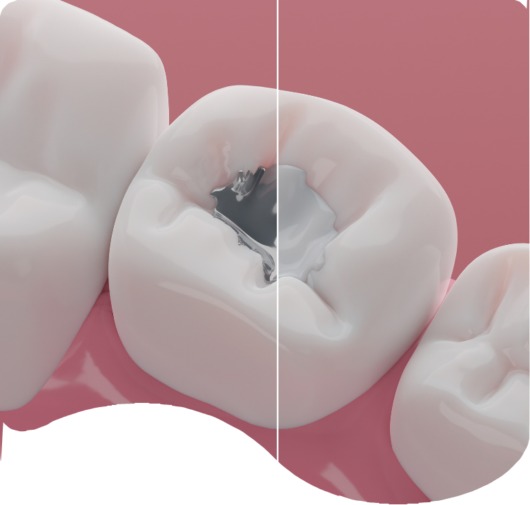 Safe Amalgam Removal