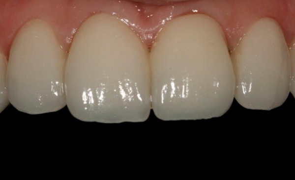 Porcelain Veneers - Case 2 before