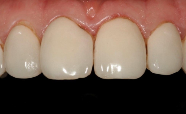 Porcelain Veneers - Case 2 after