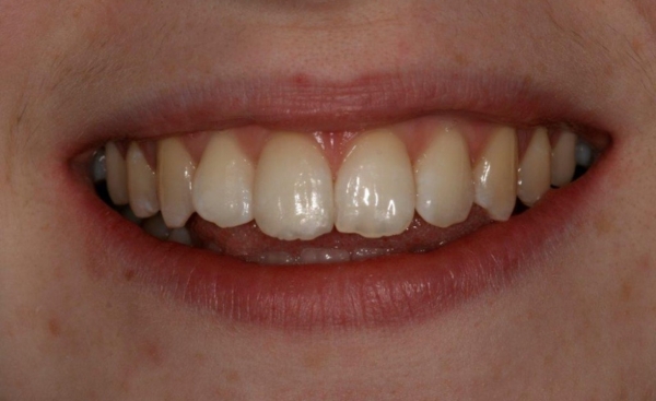 Chipped tooth after
