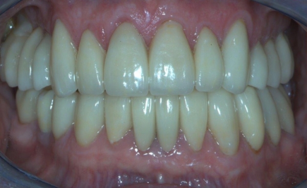 Porcelain Veneers - Case 3 after