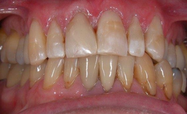 Porcelain Veneers - Case 3 before