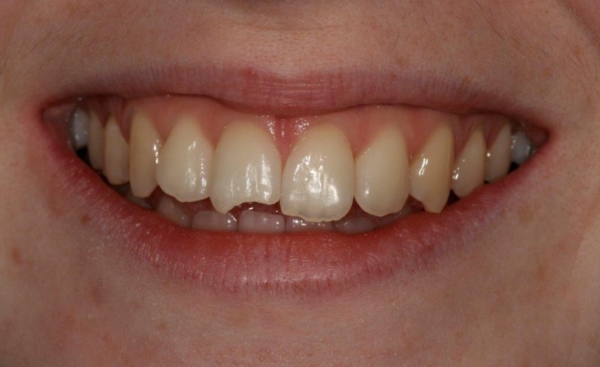 Chipped tooth after