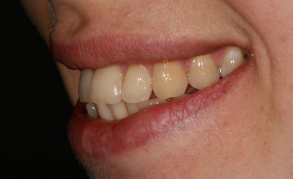 Porcelain Veneers - Case 4 before