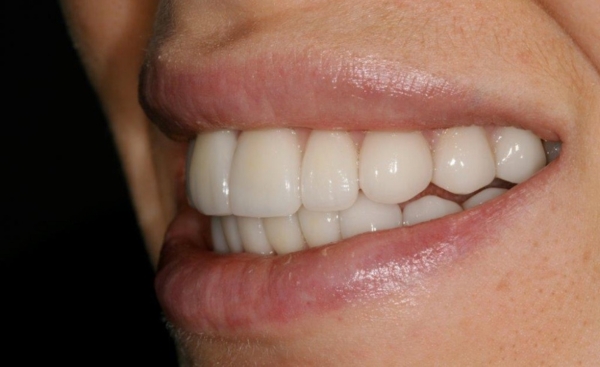 Porcelain Veneers - Case 4 before